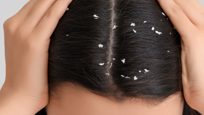 Giữ da đầu sạch, cân bằng và không bong tróc là nền tảng cho tóc khỏe