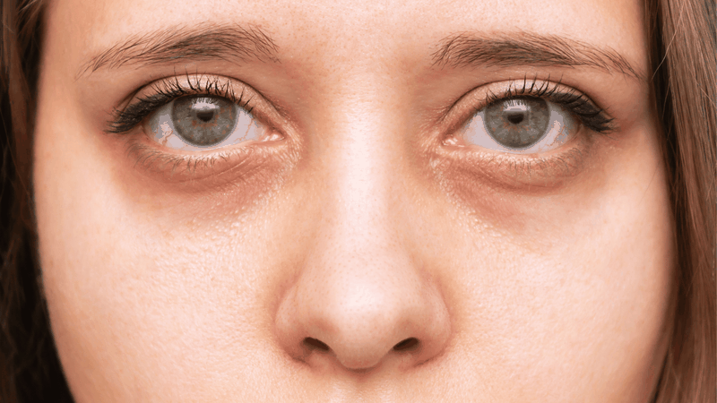 Thiếu ngủ, thức khuya và stress làm rối loạn nhịp sinh học, khiến tuần hoàn máu kém và làm quầng thâm mắt trở nên đậm màu hơn