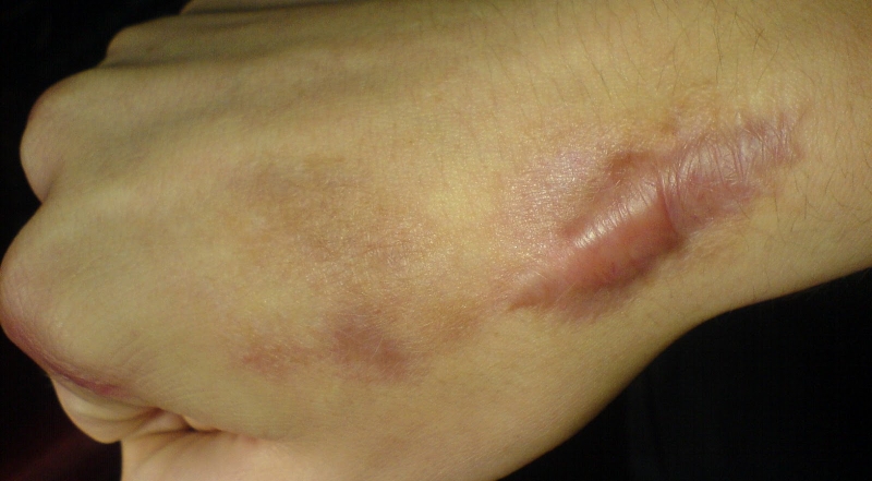 5 cách làm sẹo lồi hết ngứa hiệu quả 1