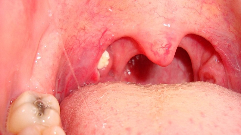 Áp xe thành họng cũng tạo thành hạt trắng trong họng