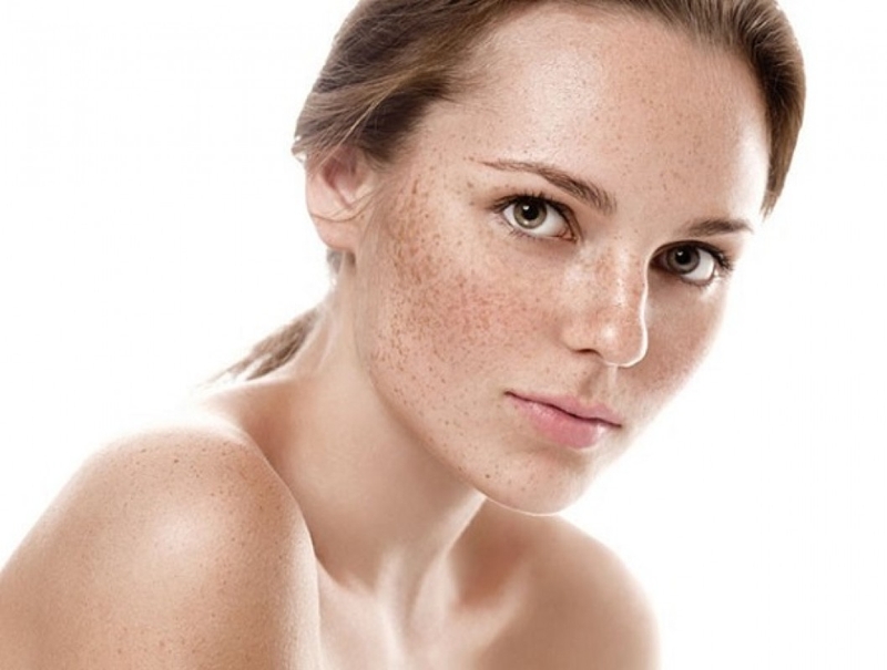 5 cách trị đồi mồi hiệu quả tại nhà bạn không thể bỏ qua