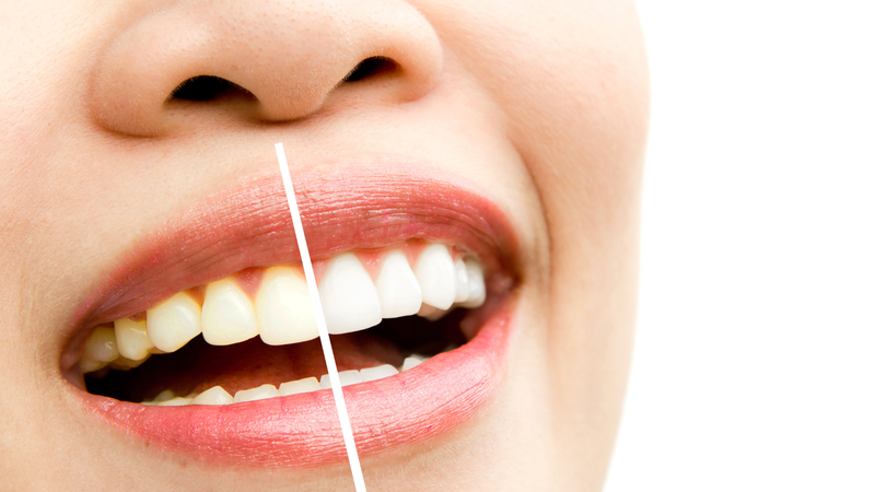 Răng có thể bị xỉn màu bởi cà phê