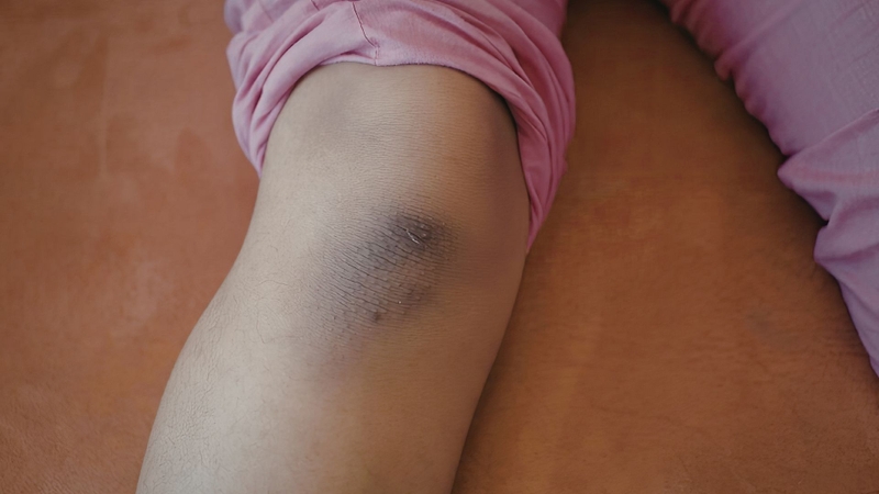 Khi chức năng gan suy giảm, máu khó đông hơn, dễ gây bầm tím