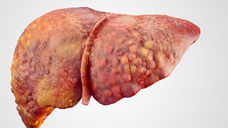 Rượu bia là một trong những nguyên nhân hàng đầu dẫn đến xơ gan