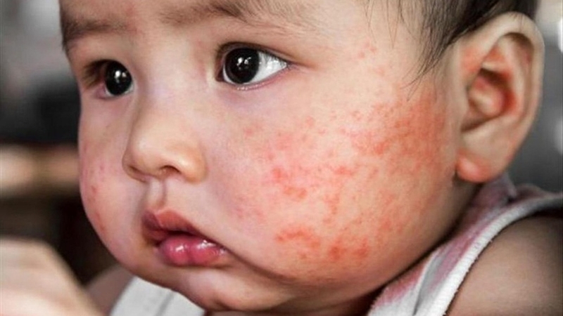 5 loại thuốc bôi ngoài da trị ngứa cho trẻ em an toàn và hiệu quả 1