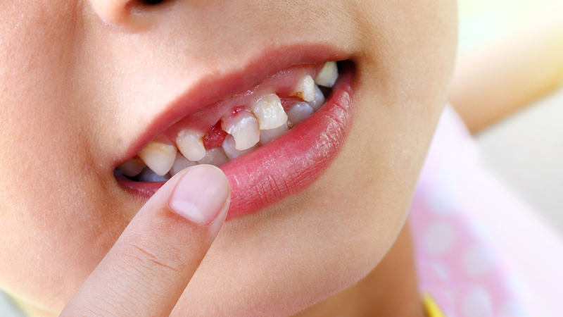 Lượng acid trong nước ép lựu có thể làm ảnh hưởng đến men răng của trẻ em