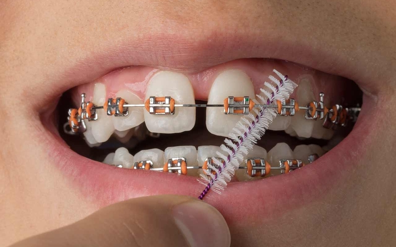 5 sự thật về phương pháp mài kẽ răng - Đọc ngay! 6