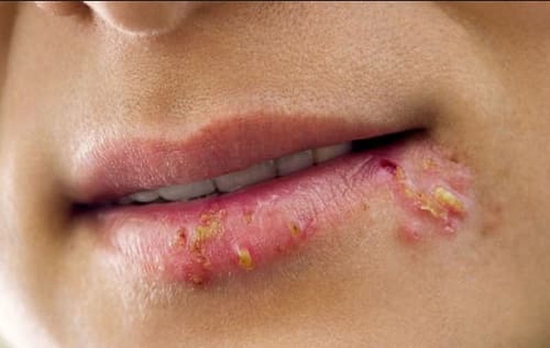 Mụn rộp sinh dục miệng liệu có nguy hiểm? 1