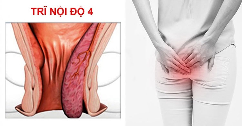 Bỏ túi các dấu hiệu của bệnh trĩ cấp độ 4 để đề phòng 1