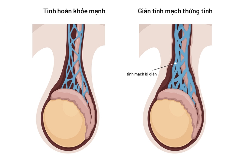 Cách chữa xệ tinh hoàn và những lưu ý quan trọng mà nam giới cần biết