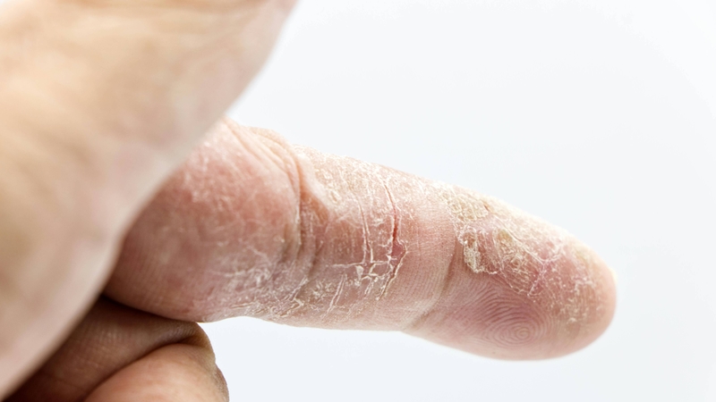 Tăng nguy cơ nhiễm trùng bao gồm nhiễm nấm da, niêm mạc, nhiễm trùng da