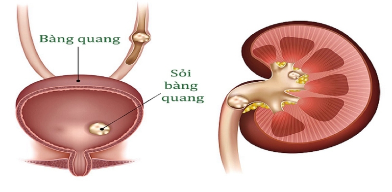 6 cách chữa sỏi bàng quang dân gian tại nhà hiệu quả 3