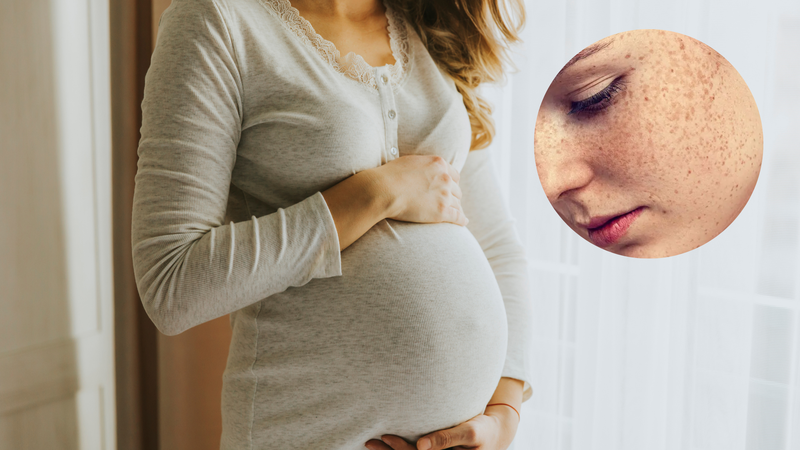 Bà bầu rất dễ bị nám sạm da
