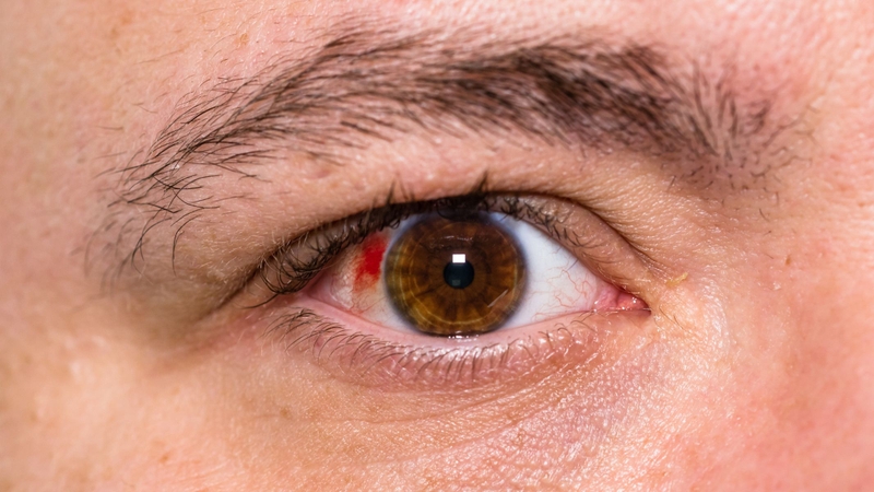 6 cách làm tan vết tụ máu trong mắt​ 1