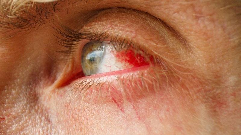 6 cách làm tan vết tụ máu trong mắt​ 4