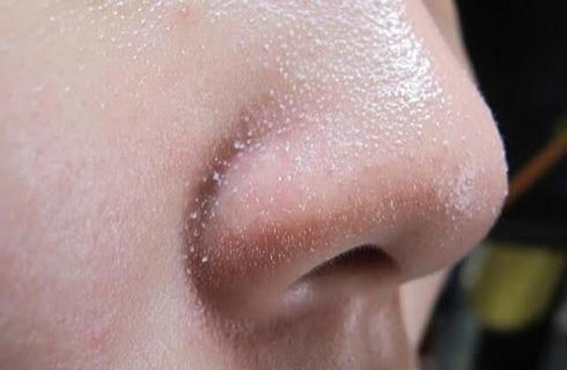 6 cách loại bỏ sợi bã nhờn dễ dàng bạn đã biết chưa?2