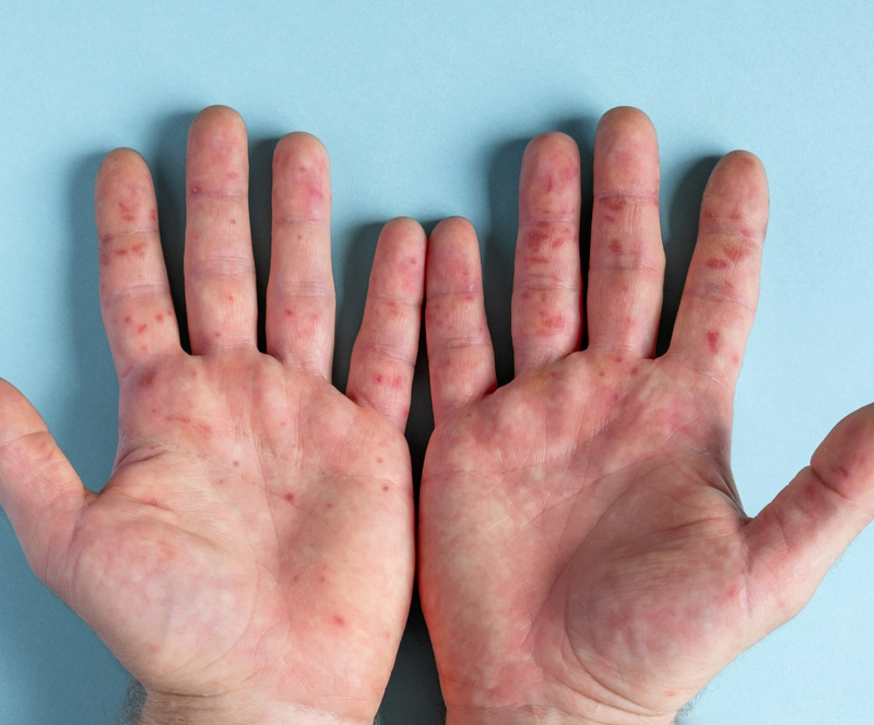 6 cách phòng bệnh tay chân miệng hiệu quả dành cho trẻ1