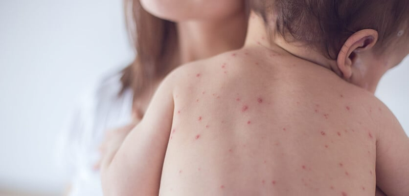 6 cách phòng bệnh tay chân miệng hiệu quả dành cho trẻ2