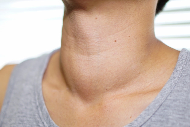 Tuyến giáp sưng to là dấu hiệu điển hình của ung thư tuyến giáp