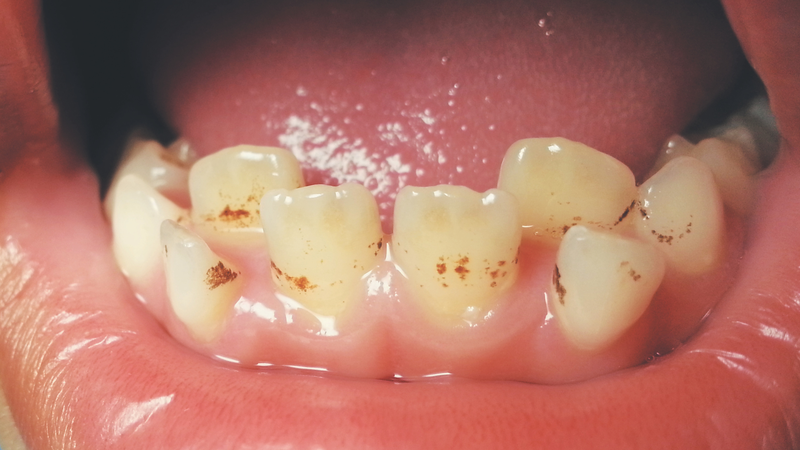 Nên khám nha khi xuất hiện những vết ố nâu, đen cứng đầu