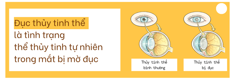 70% ca mù lòa liên quan đục thủy tinh thể: Người cao tuổi cần lưu ý gì? 3