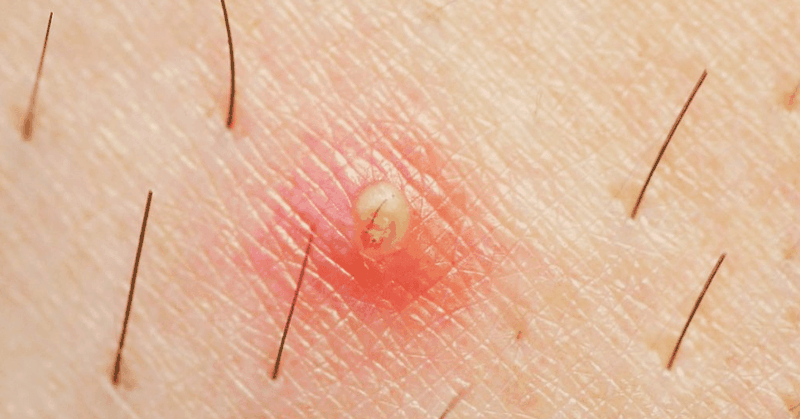 Lông nách mọc ngược là gì? Nguyên nhân nào gây ra hiện tượng này? 1