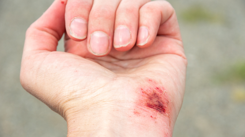 7 dấu hiệu cơ thể đang thiếu vitamin D thường bị bỏ qua 1