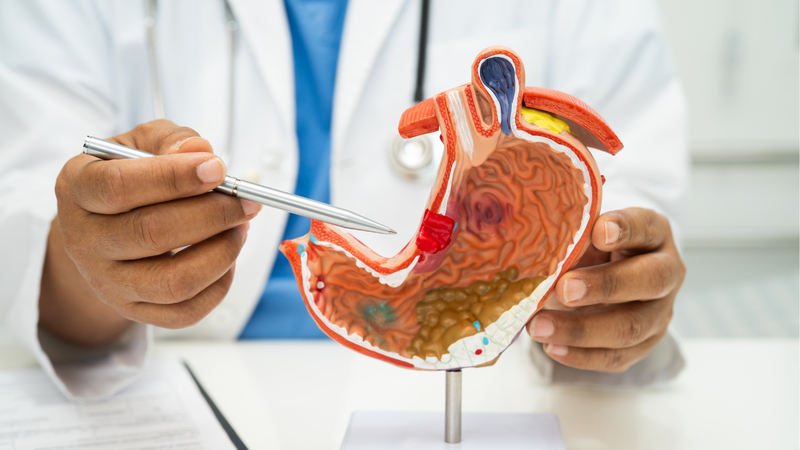 Phân giai đoạn ung thư dạ dày là bước thiết yếu để xác định mức độ xâm lấn