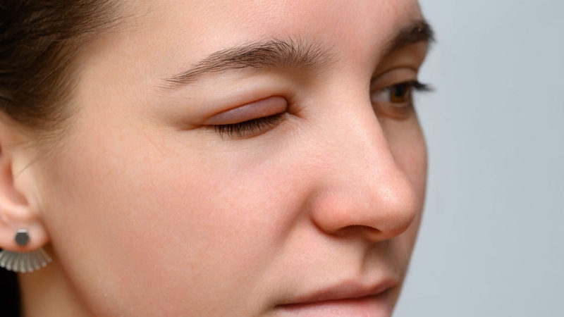 Ngủ dậy mắt bị sưng bởi những nguyên nhân không ngờ đến 2