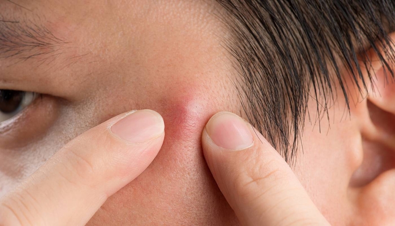 7 sai lầm khi điều trị mụn trứng cá khiến mụn càng nhiều, trị không khỏi 2