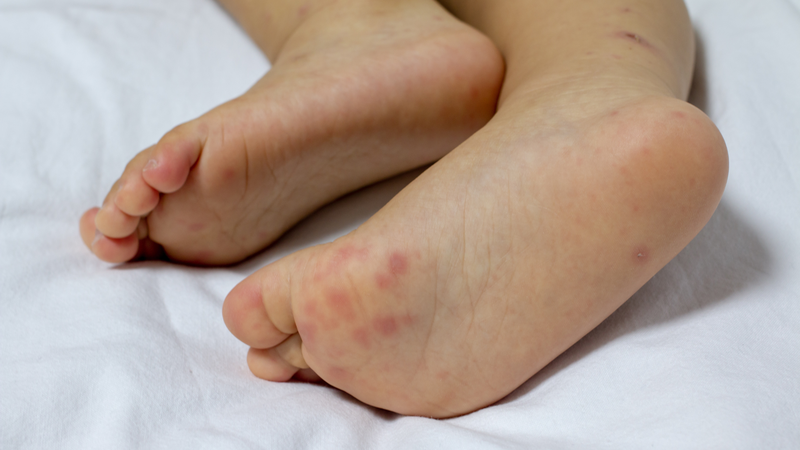 Nguyên nhân khiến tay chân miệng tiến triển nặng