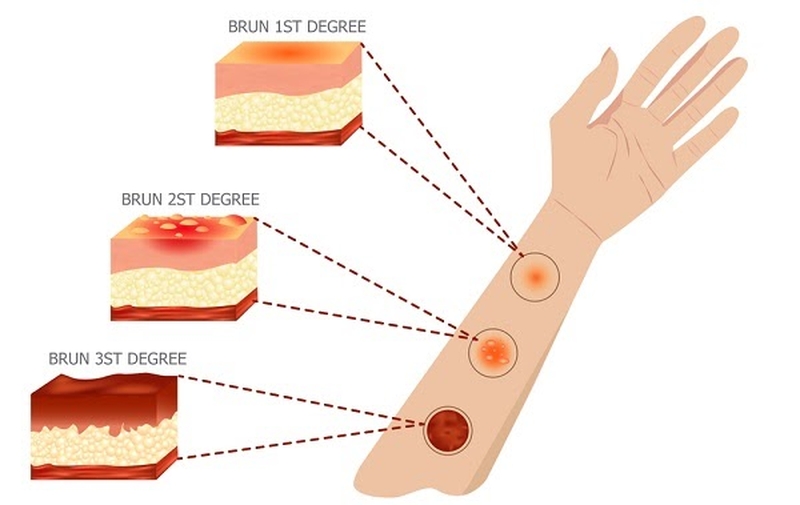 Cách sơ cứu hiệu quả khi bị bỏng hơi nước 1