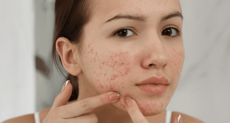 Mẫn cảm là gì? Hội chứng mẫn cảm với thành phần của thuốc là như thế nào? 3