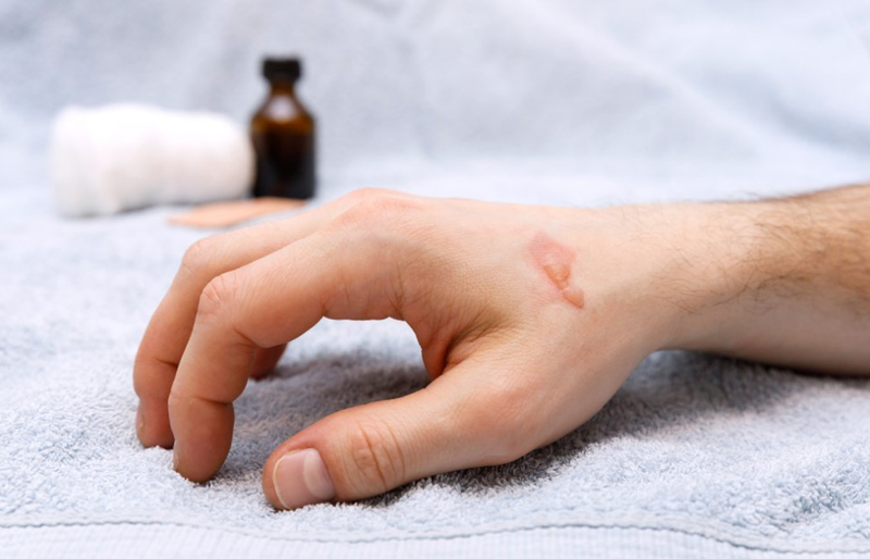 8 cách trị bỏng tại nhà dễ thực hiện nhưng hiệu quả không ngờ 1