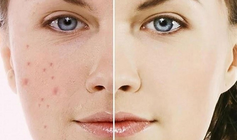 8 cách trị thâm mụn bằng sữa tươi không đường hiệu quả nhất 1