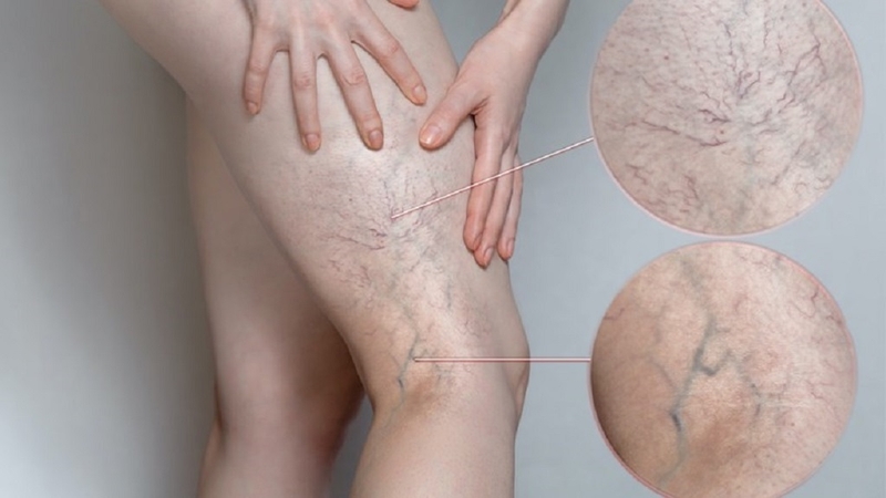 8 cách tự nhiên chữa giãn tĩnh mạch tại nhà hiệu quả bạn cần biết 2