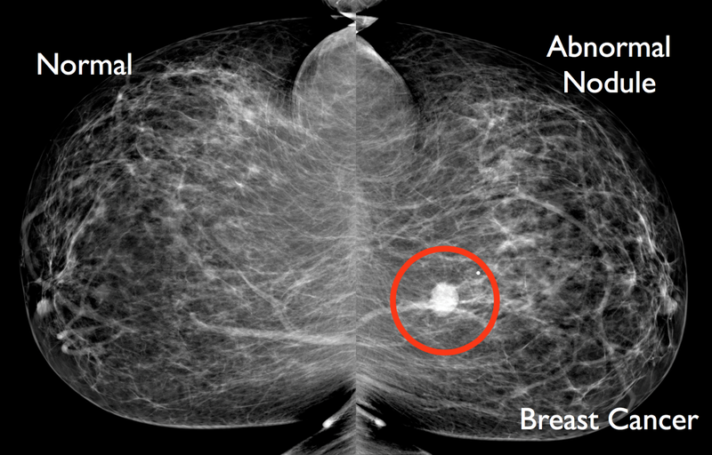 8 lầm tưởng phổ biến về sàng lọc vú