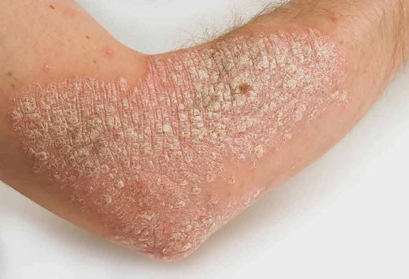 8 phương pháp phổ biến nhất trong điều trị ung thư da có thể bạn chưa biết 4