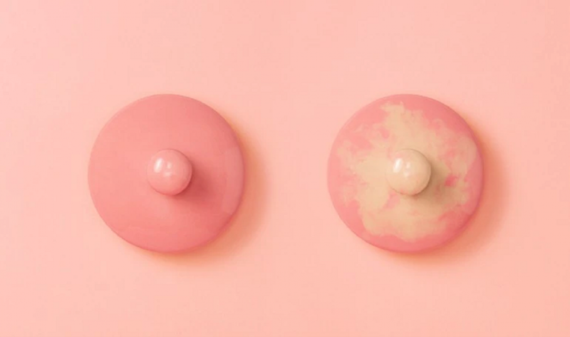 Nổi cục ở nhũ hoa: Dấu hiệu u lành tính và u ác tính 5