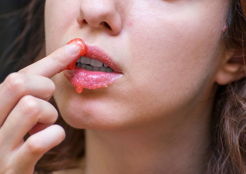 9 cách trị môi khô nứt nẻ tại nhà đơn giản, tiết kiệm 4