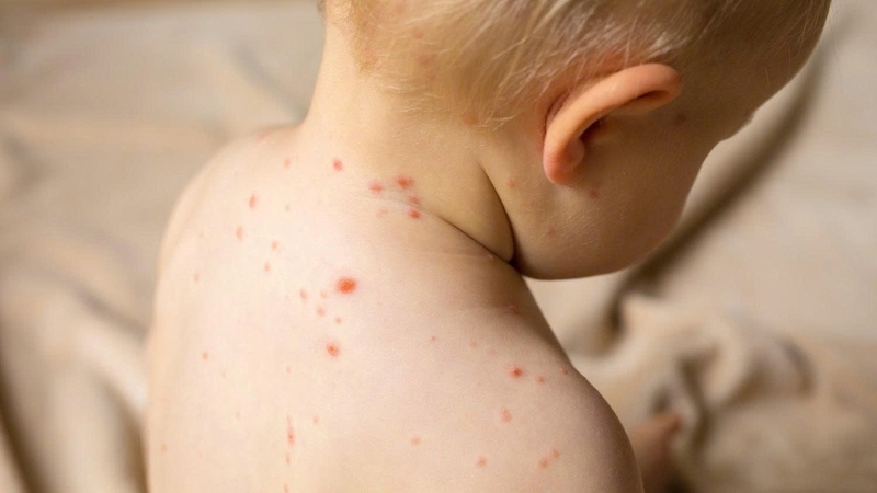 Kem chứa Panthenol giúp làm dịu viêm, tăng cường độ ẩm và hỗ trợ tái tạo mô da mới