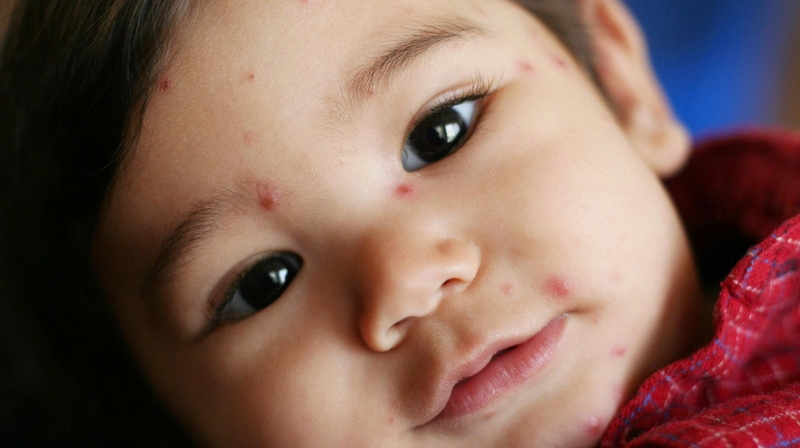 Sau khi các nốt thủy đậu bắt đầu lành, gel silicone được sử dụng để hỗ trợ ngừa sẹo