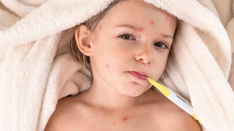 Người bệnh có thể được chỉ định thuốc hạ sốt, giảm đau hoặc kháng histamine để giảm ngứa