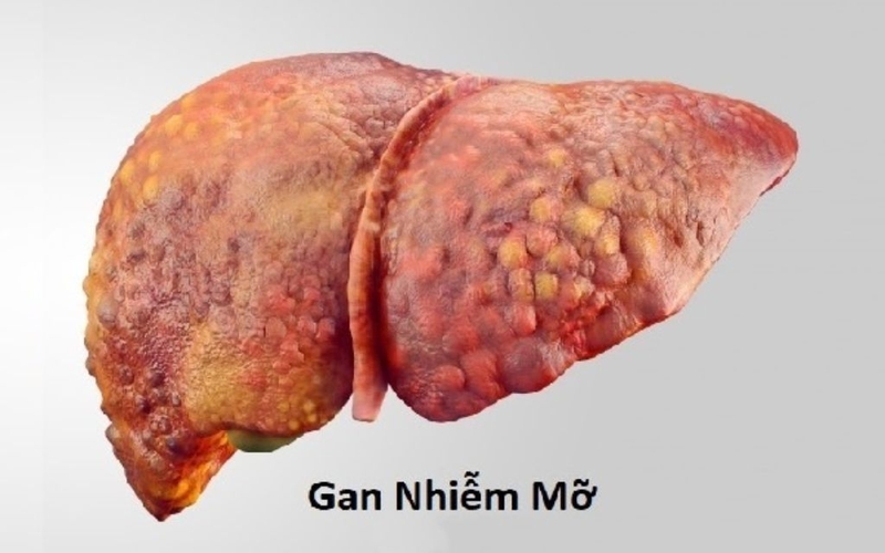 Âm gan tăng là gì, gây nguy hiểm không? Cần làm gì để bảo vệ gan? 2