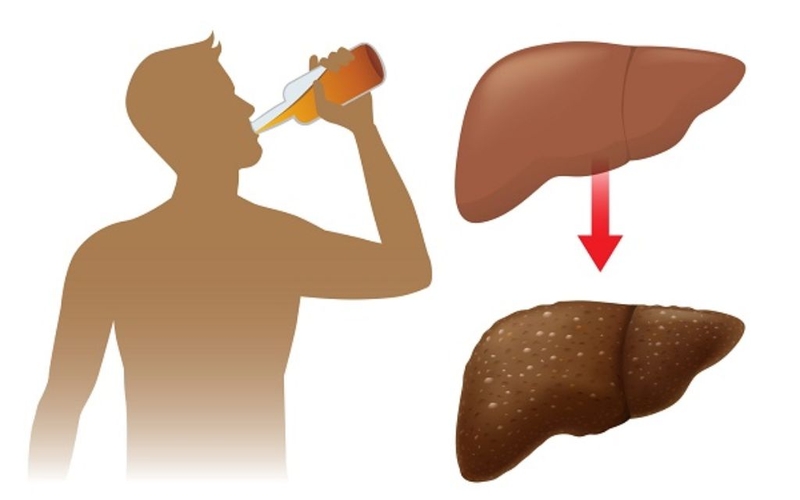 Âm gan tăng là gì, gây nguy hiểm không? Cần làm gì để bảo vệ gan? 4