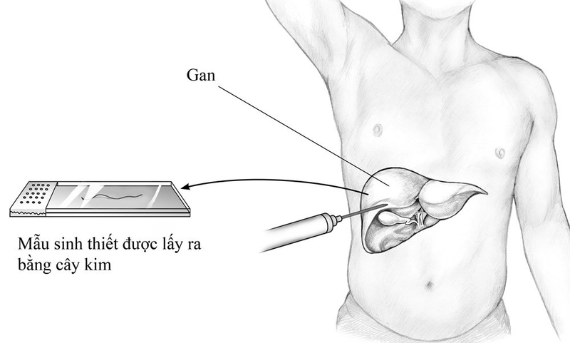 Âm tính giả trong kết quả sinh thiết 02