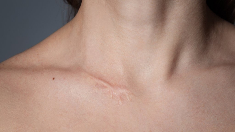 Ăn ghẹ có bị sẹo lồi không? Các thực phẩm cần tránh khi đang có vết thương hở 2