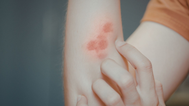 Anthralin có thể gây kích ứng da tại chỗ bôi