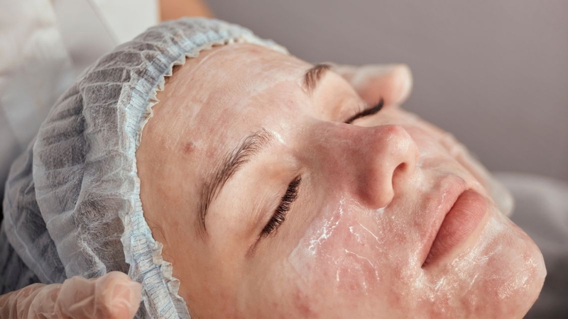 Azelaic acid có đẩy mụn không? Hiểu đúng trước khi sử dụng 3