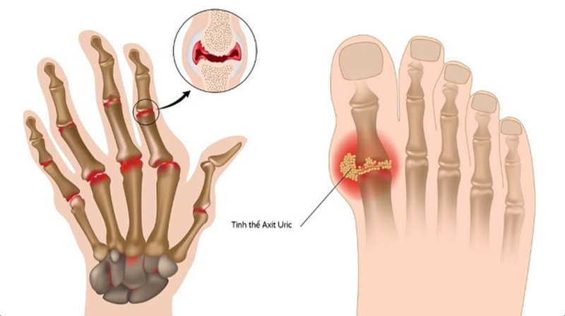 Bệnh cấp tính là gì? Sự khác nhau giữa bệnh cấp tính và bệnh mãn tính 4